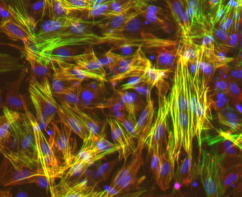 Photo: UW–Madison researchers studied smooth muscle cells like these, derived from induced pluripotent stem cells, to show that long-mysterious variations in an area of our genome harden blood vessels, puting some people at higher risk for cardiovascular disease. Image courtesy Lo Sardo Lab/UW–Madison