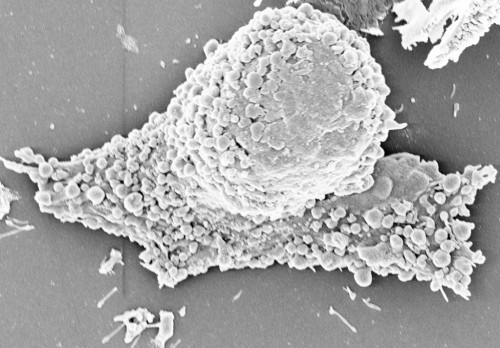 Image showing the formation of pyroptotic vesicles, which look like small bubbles, in cancer cells as they undergo programmed cell death. A team of researchers led by UW–Madison pharmacy professor Quanyin Hu have developed a method for harnessing these vesicles to deliver vaccines against tumors with a high rate of recurrence. Image courtesy of Quanyin Hu